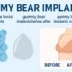 gummy bear implants