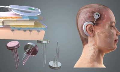 Illustration of brain chip technology showing a neural implant embedded in the human brain with glowing digital connections.