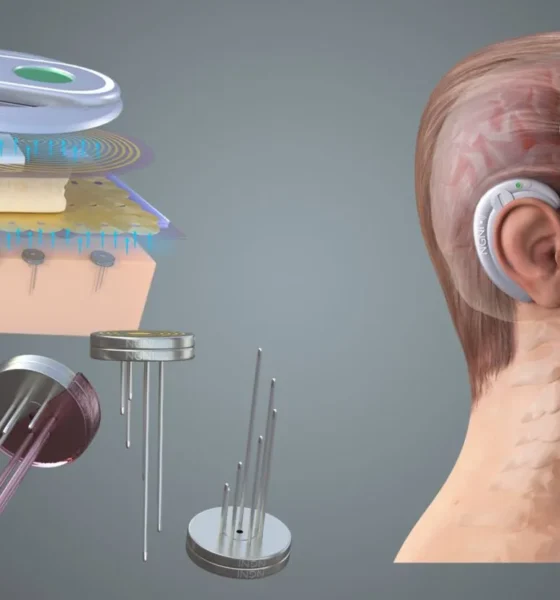 Illustration of brain chip technology showing a neural implant embedded in the human brain with glowing digital connections.